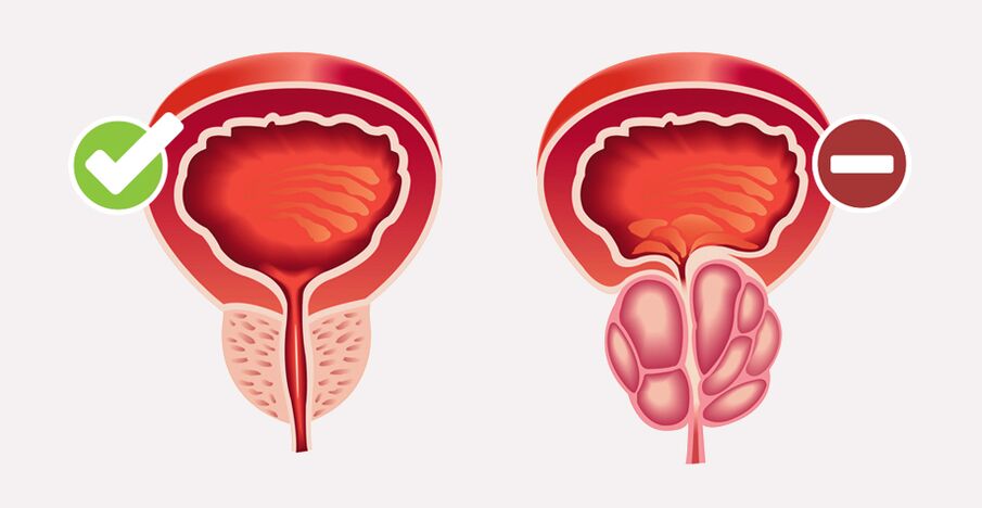 Weiprost normalisiert die Größe und Funktion der Prostata