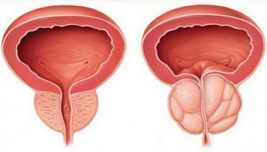 gesunde und entzündete Prostata mit Prostatitis