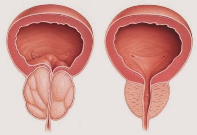 gesunde und entzündete Prostata mit Prostatitis