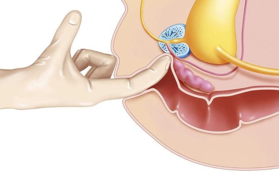 Prostatamassage zur Behandlung von Prostatitis