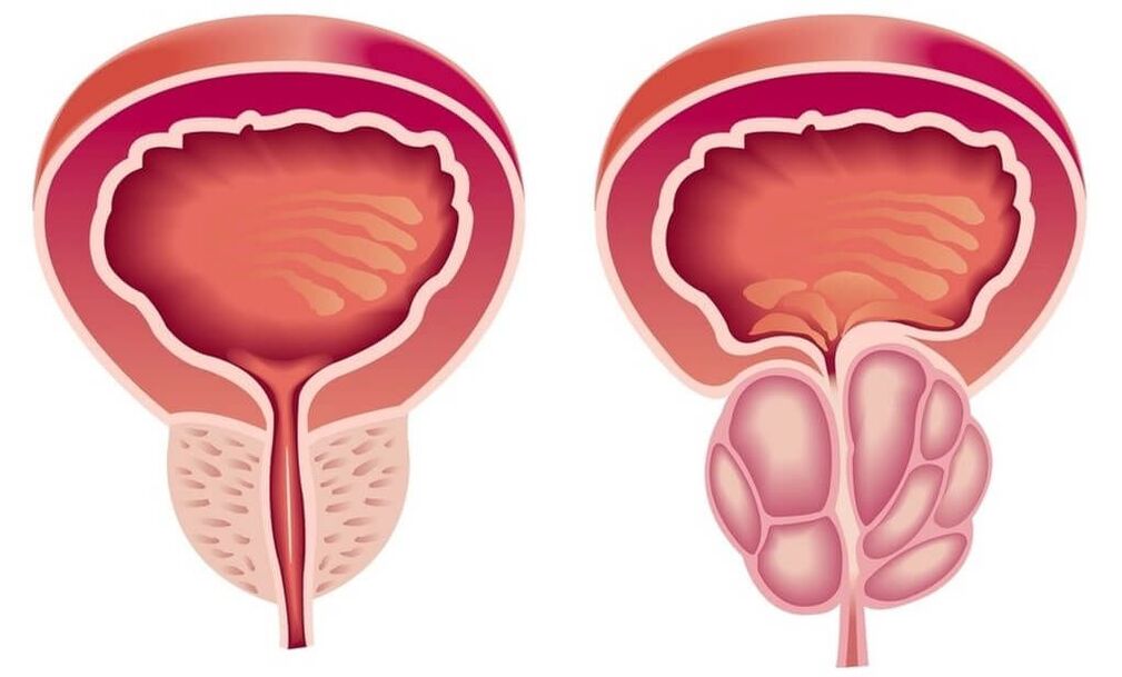 gesunde und kranke Prostata